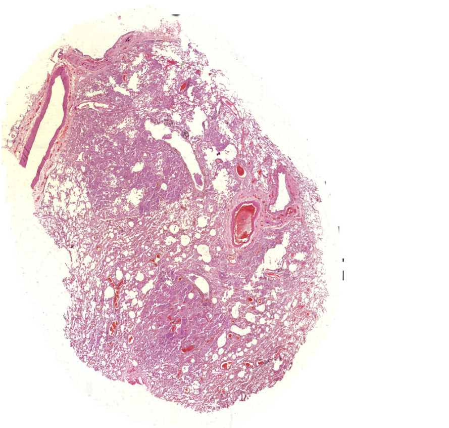 bronchopneumonia