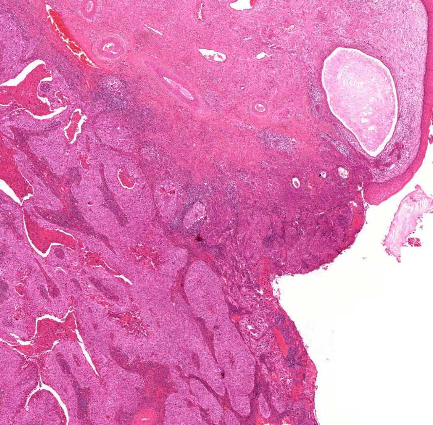 carcinoma cervicis invazív