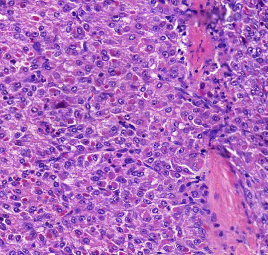 Carcinoma hepatocellulare globulusok