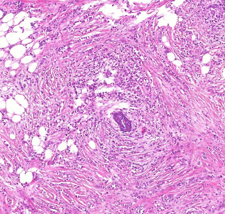 carcinoma lobulare invasivum mammae ductus körül