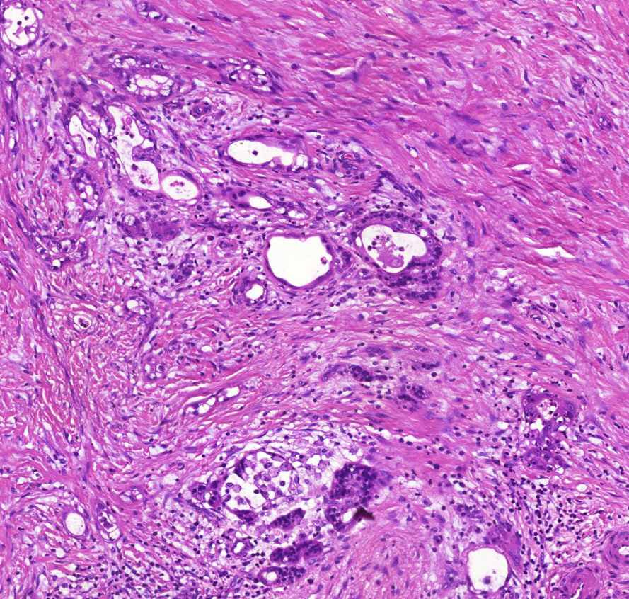 carcinoma pancreatis0