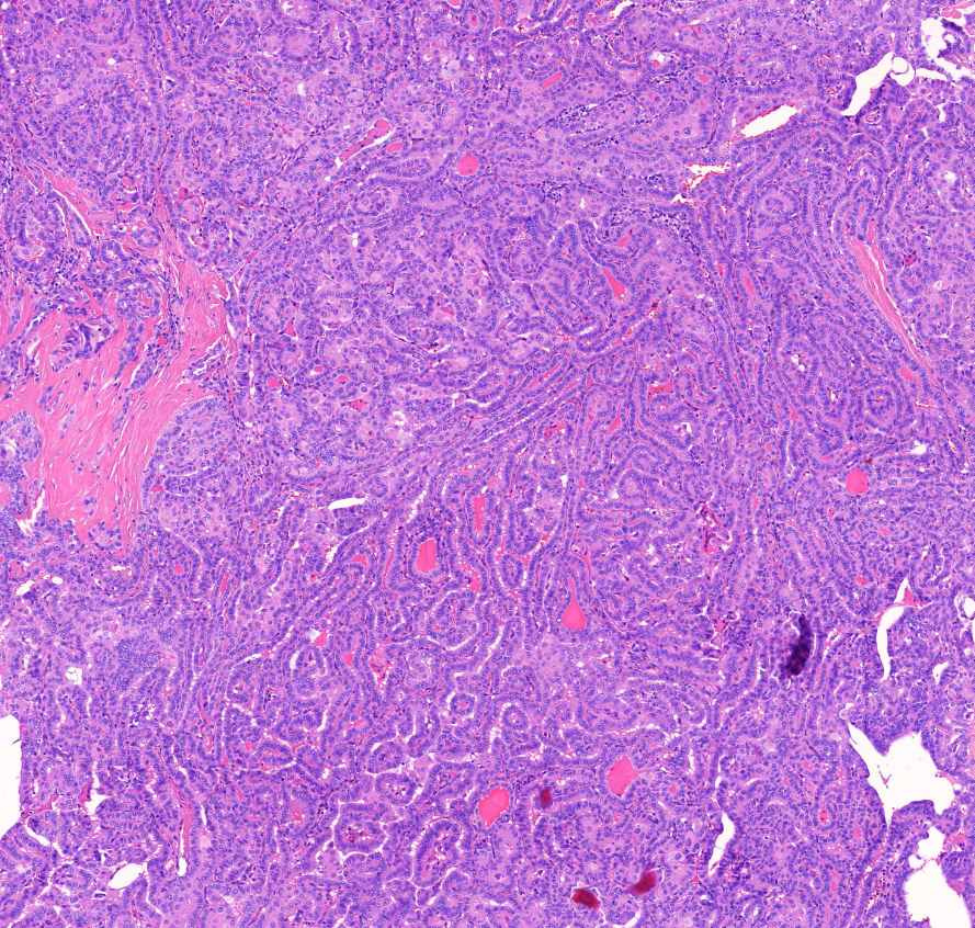 carcinoma papillare thyroideae1