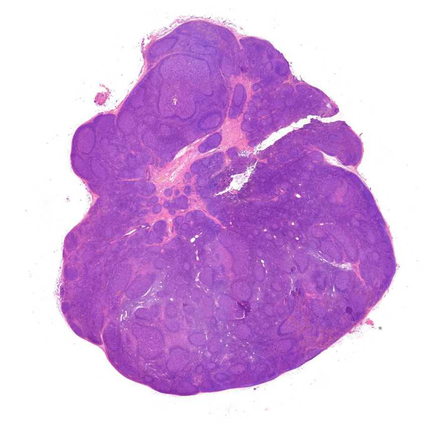 follicularis hyperplasia