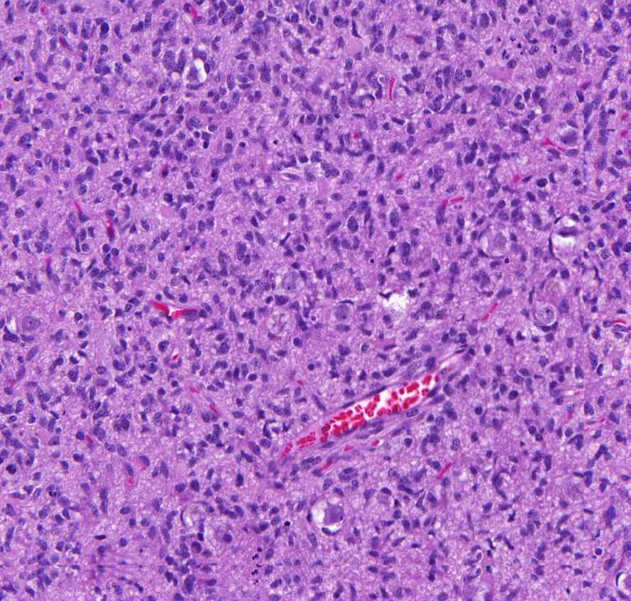 glioblastoma multiforme0