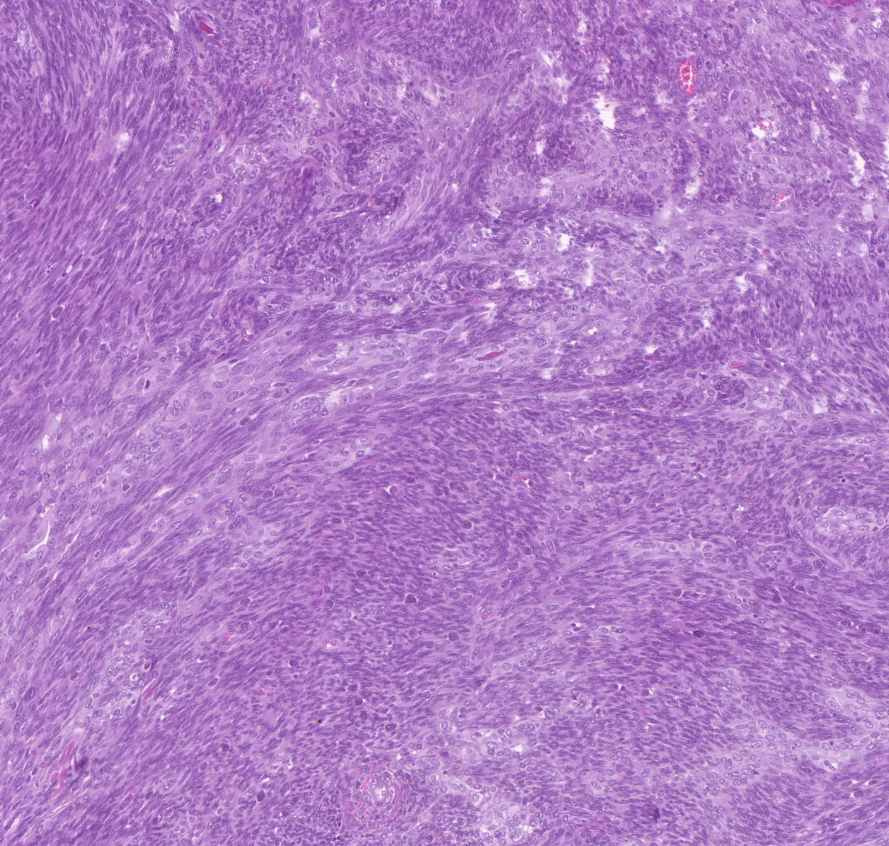 synovialis-sarcoma1