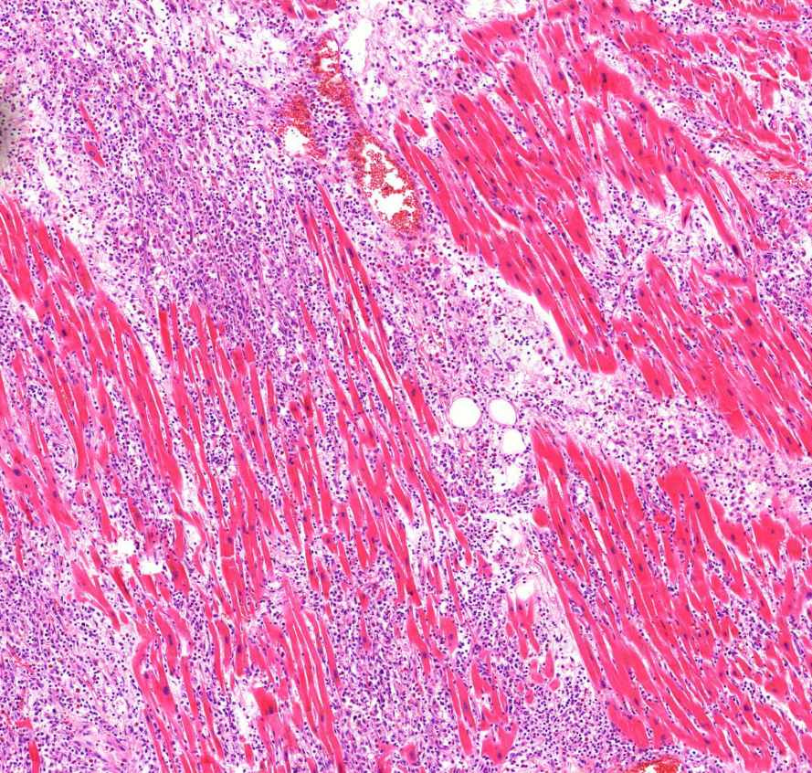 virusos myocarditis1