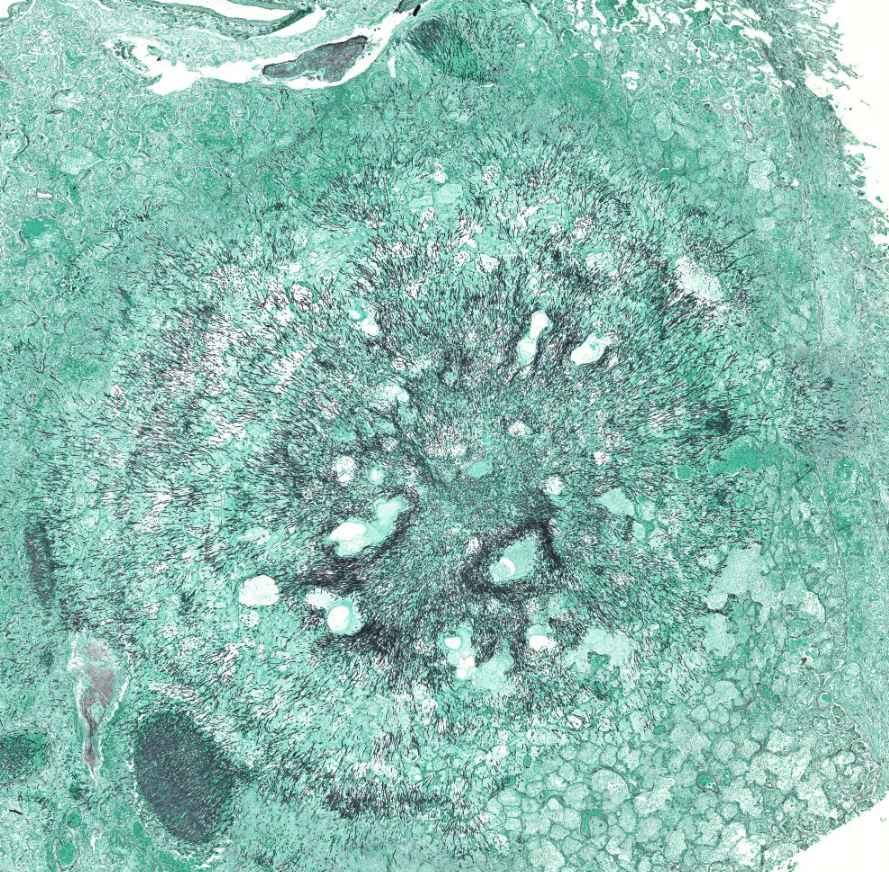 Aspergillosis (grocott) 1