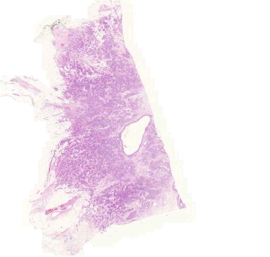 carcinoma ductale invasivum mammae