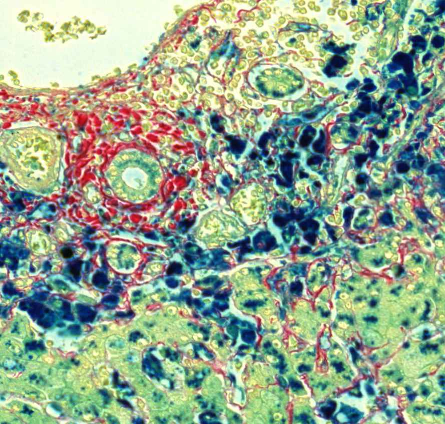 haemosiderosis hepatis (Berlini-kék)7