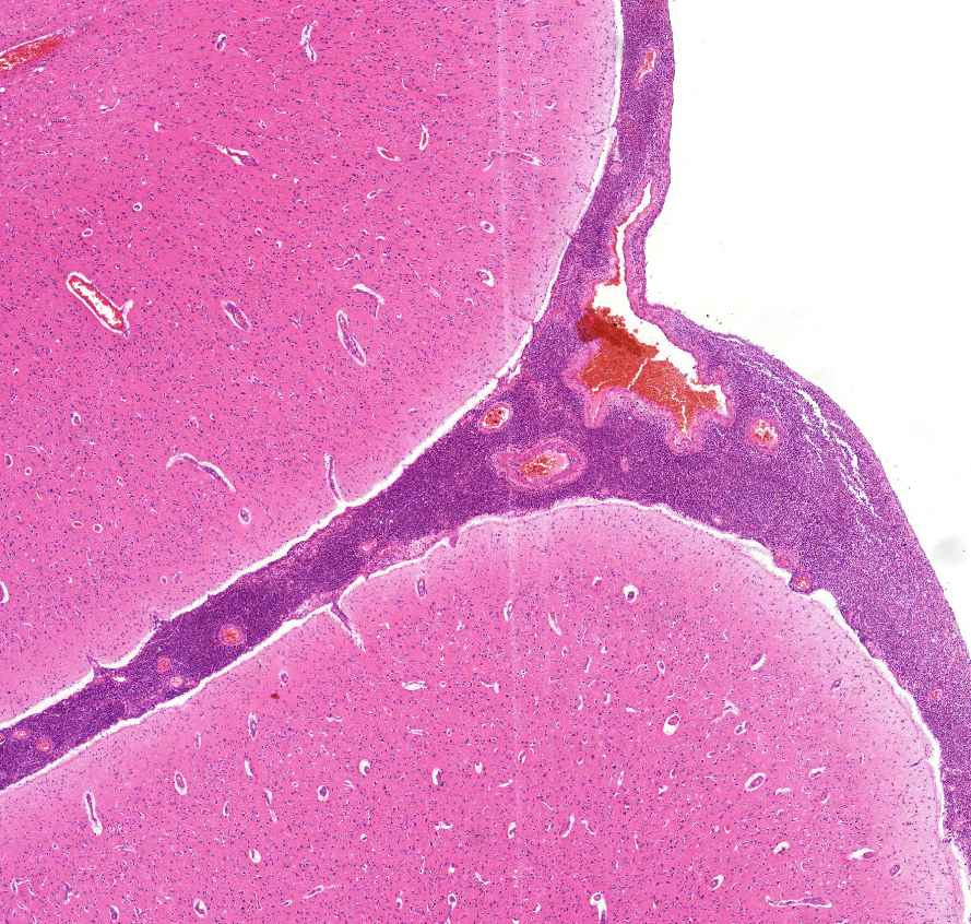 meningitis purulenta0