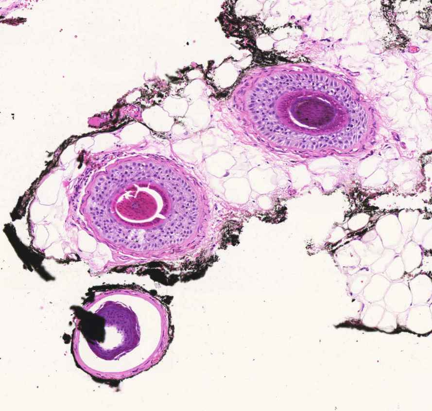 naevus intradermalis cutis3