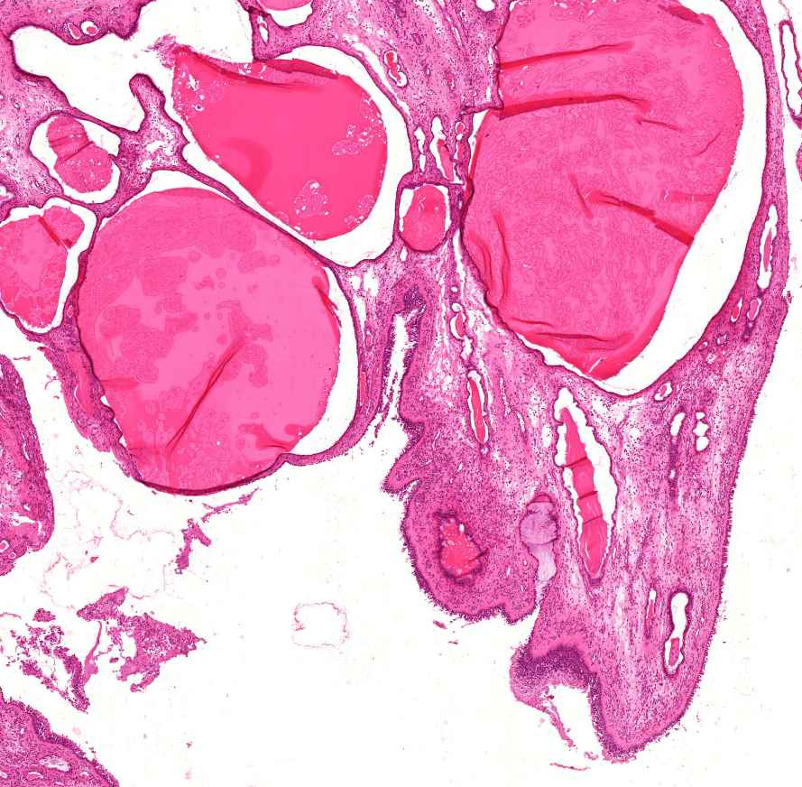 polypus allergicus nasi csillós hh